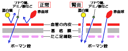 腎炎