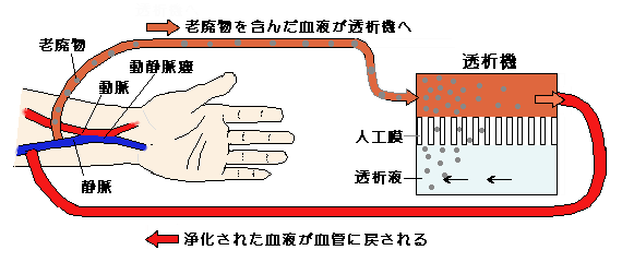 ダイアライザーによる人工透析