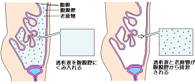 腹膜透析による人工透析