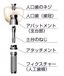 インプラントとは