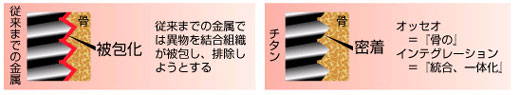 インプラントの素材1