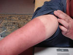 SUN BURN