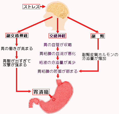 胃潰瘍とストレスの関係