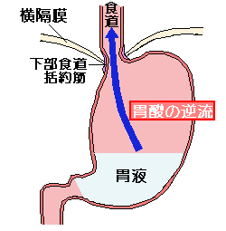 胃酸過多症