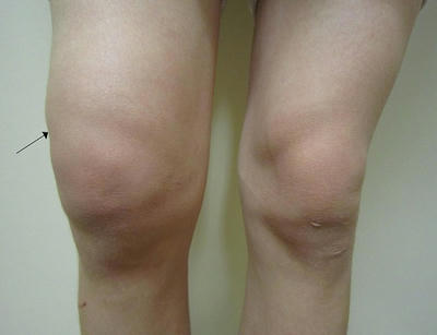 Tràn dịch khớp gối là bệnh gì ?