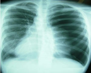 spontaneous_pneumothorax.jpg