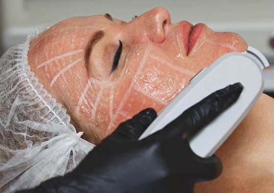Can High-Intensity Focused Ultrasound Treatment Replace Face Lifts?