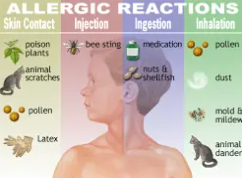 Allergies - Symptoms and causes