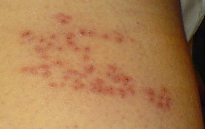 Lưu &yacute; khi điều trị bệnh zona thần kinh