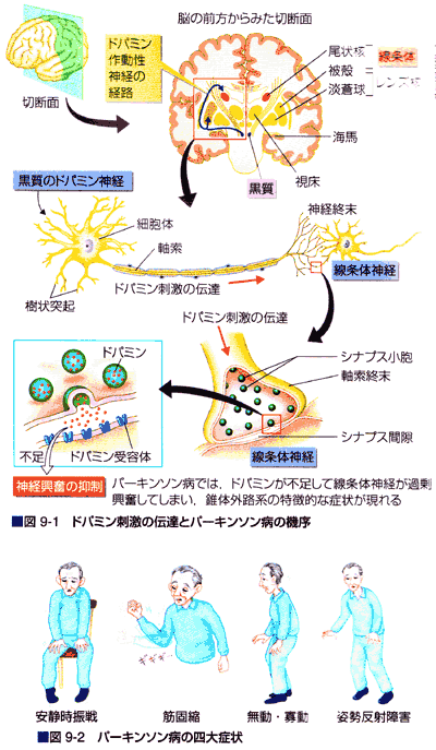 パーキンソン病