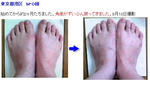 外反母趾プログラム*実践者1