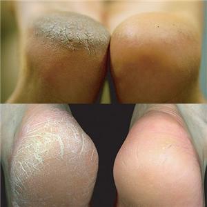 Pedix　Foot Peel