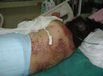Stevens-Johnson Syndrome, SJS