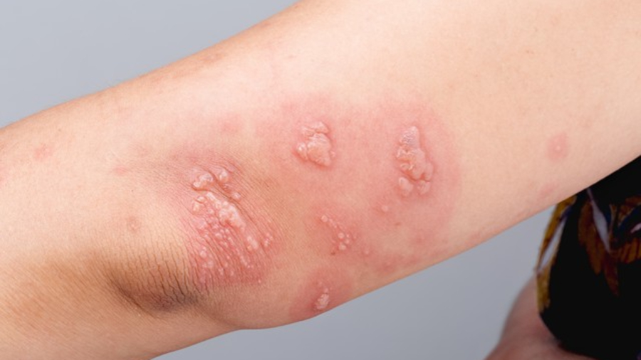 帯状疱疹の症状とは?どのように診断し、予防するのですか?
