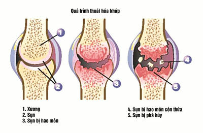 Các biểu hiện của viêm khớp thoái hóa