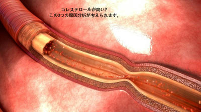 コレステロールが高い？ この3つの原因分析が考えられます。