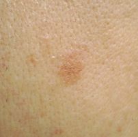 シミ　ざらつき