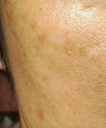 シミ画像　右頬