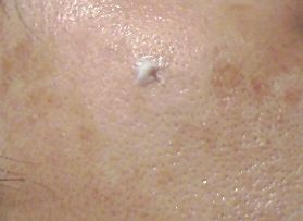 クイノール塗布