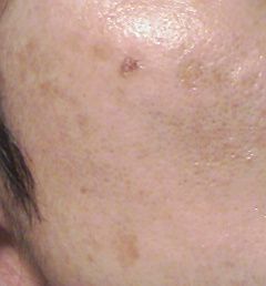 シミ取り　画像　5日目