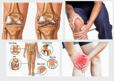Các bệnh về xương khớp phổ biến