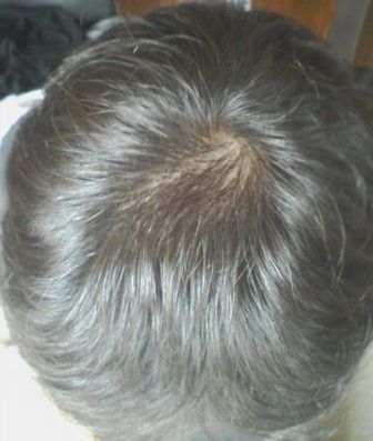 薄毛画像　頭頂部