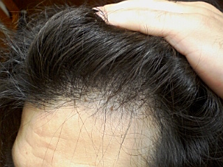 薄毛回復画像　M字左