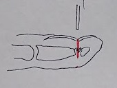 怪我した指の図