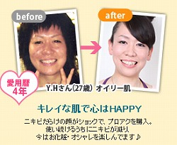 プロアクティブ大人 にきび 治すスキンケア プロアクティブ 激安通販