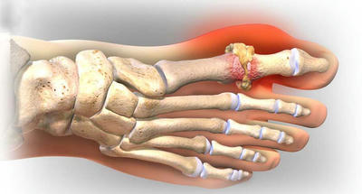 Gout là bệnh như thế nào ?