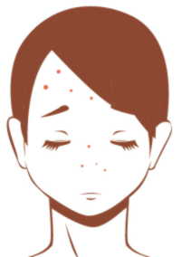 女性顔ニキビ