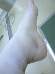 アキレス腱断裂手術後14日目
