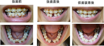抜歯 右下１番 おとなの歯列矯正ブログ