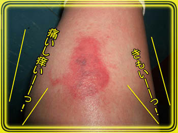 血管から毒素がーーーっ！（泣）