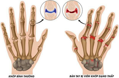 Viêm khớp dạng thấp là bệnh gì ?