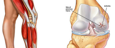 Bệnh viêm khớp gối và cách điều trị
