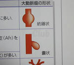 大動脈瘤の形態