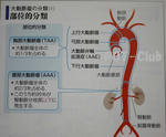 大動脈瘤の部位による分類
