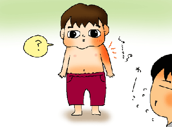 腫れてますー