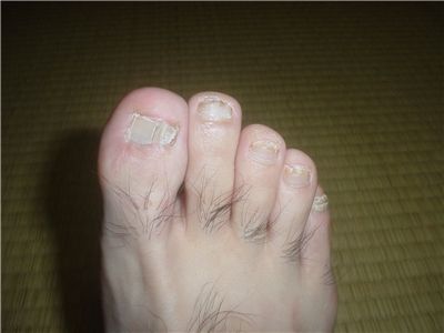 爪水虫治療中の右足