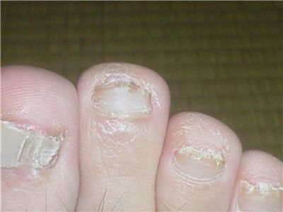 爪水虫治療中の右足中指