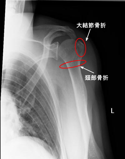 上腕骨（左腕）の骨折箇所