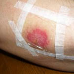 wound2.jpg