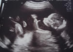 エコーを通して見えた赤ちゃん