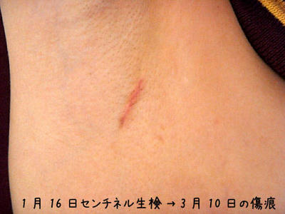 センチネルリンパ節生検傷痕