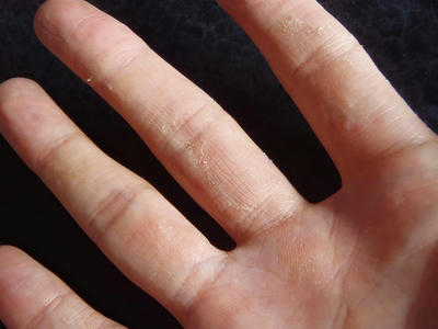 汗疱の治った痕。手のひら側の指