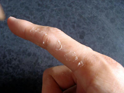 汗疱の治った痕。右手人差し指側面