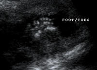 Baby foot/toe 16w4d
